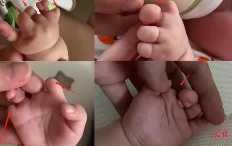 微促试管婴儿技术安全性探讨